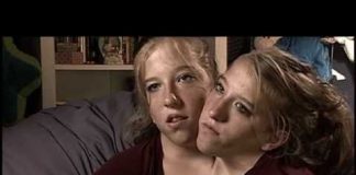 The Twins Who Share a Body