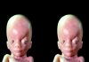 In the Womb: Identical Twins