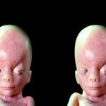 In the Womb: Identical Twins