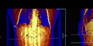 The Weight of the Nation: Consequences